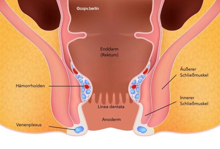 Hämorrhoiden: Welcher Arzt ist der richtige? hämorrhoiden welcher arzt