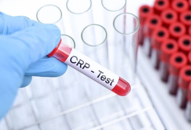 CRP Wert: Normalwerte und Bedeutung crp wert